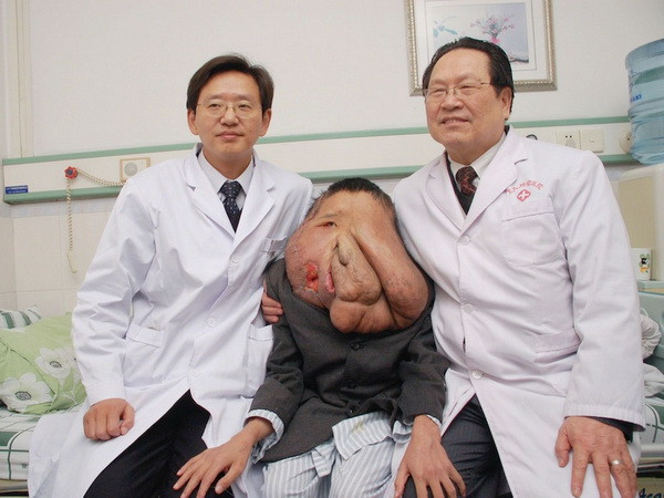 "Người đàn ông mặt voi" phẫu thuật cắt khối u nặng tới 25kg ảnh 2