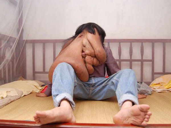 "Người đàn ông mặt voi" phẫu thuật cắt khối u nặng tới 25kg ảnh 1