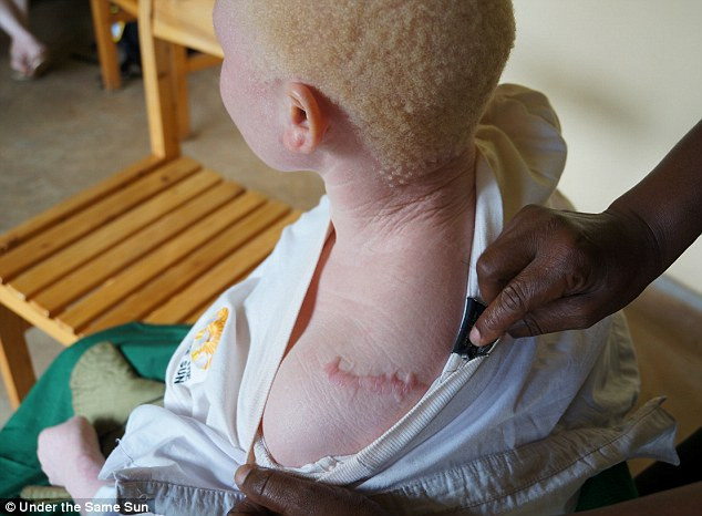 Đau xót hình ảnh cô gái bạch tạng bị chặt tay để làm thuốc phù thủy ảnh 2