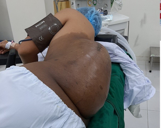 Cần Thơ: Cắt bỏ thành công khối u thần kinh nặng hơn 4,2kg ảnh 1