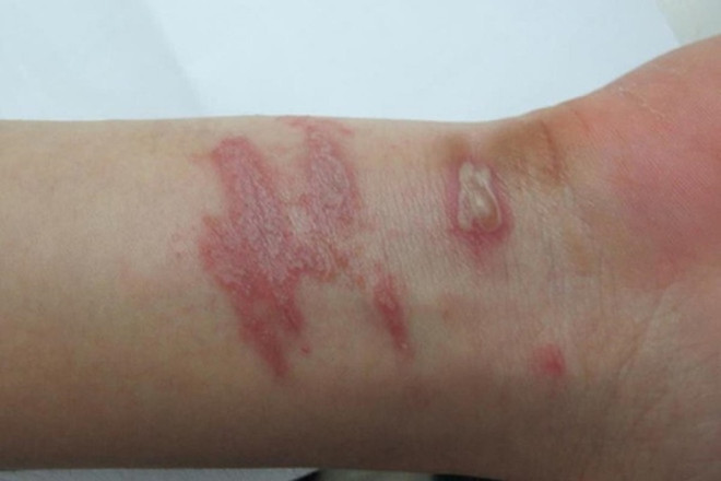 Hà Nội: Số người viêm da nặng do tiếp xúc với kiến ba khoang tăng mạnh ảnh 1