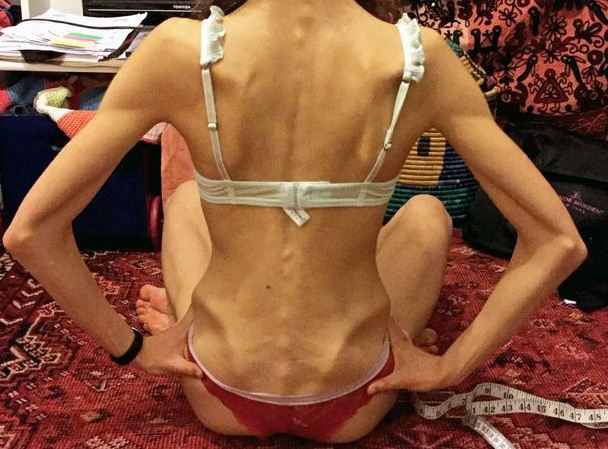 Bị chê "đùi to" vũ công balê xinh đẹp giảm xuống chỉ còn 25kg ảnh 1