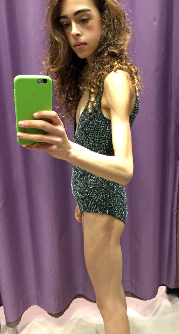 Bị chê "đùi to" vũ công balê xinh đẹp giảm xuống chỉ còn 25kg ảnh 2