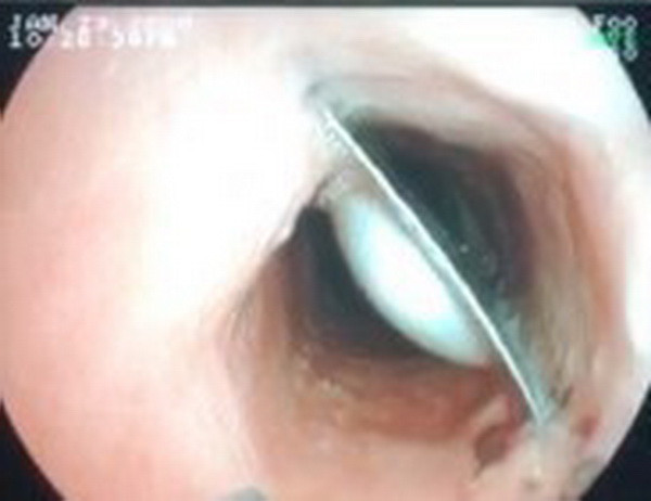 Cảnh báo nguy cơ mắc dị vật ở thực quản trong các dịp lễ, Tết ảnh 1