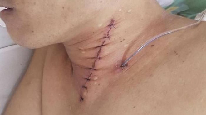 Cứu kịp thời cho một bệnh nhân bị hóc xương gà nguy hiểm tính mạng ảnh 1