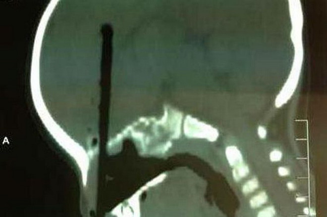 Bé trai bị chiếc đũa đâm sâu vào não do vô tình chọc qua mũi ảnh 2