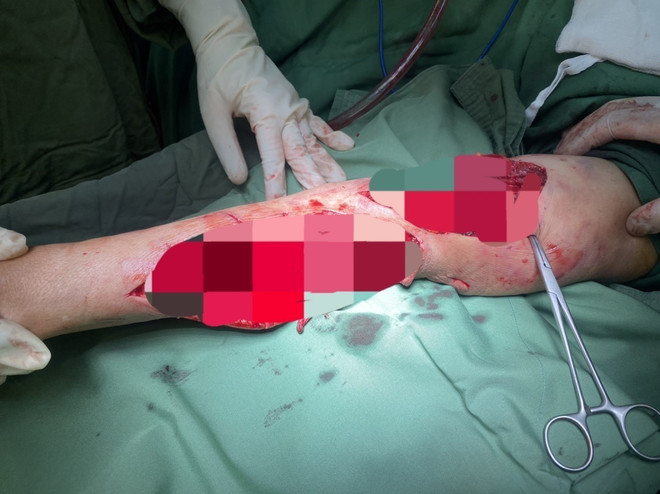 Cánh tay phải của Bà H.T.N, ngụ xã Hàm Thắng, huyện Hàm Tân, tỉnh Bình Thuận bị chính chó nhà nuôi tấn công khi đang hái rau tại vườn. (Ảnh: TTXVN phát) Bà Rịa-Vũng Tàu: Chủ nhà bị chó nuôi của gia đình cắn trọng thương ảnh 1