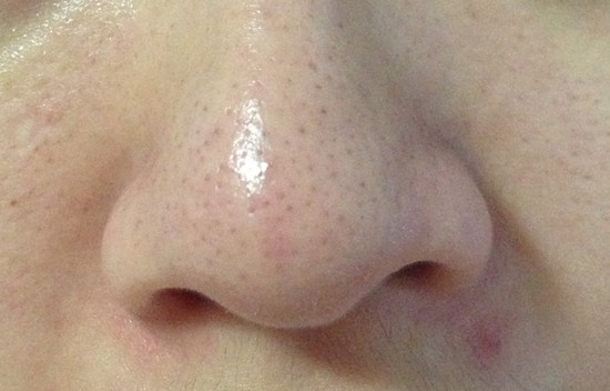 Đánh bật mụn đầu đen bằng dầu tẩy trang chỉ sau 15-20 phút ảnh 1