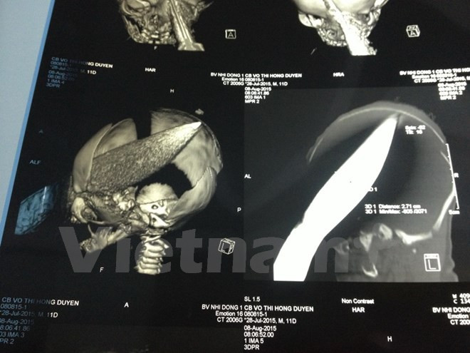 Sức khỏe bé trai sơ sinh bị dao đâm xuyên sọ đã phục hồi tốt ảnh 1