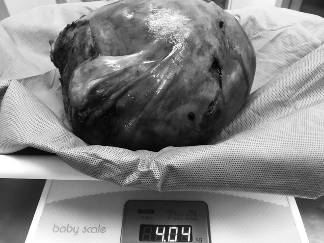 Cần Thơ: Bóc tách thành công khối u xơ tử cung nặng hơn 4kg ảnh 1