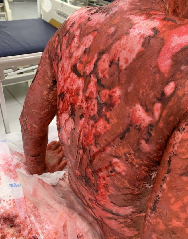 Hoại tử thượng bì nhiễm độc nặng do lạm dụng thực phẩm chức năng ảnh 2