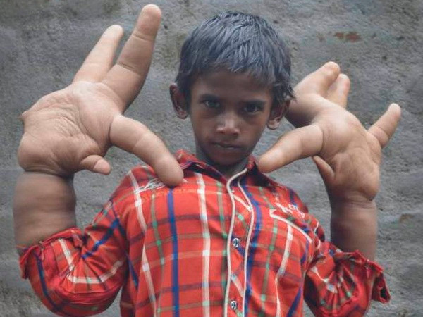 Cậu bé 8 tuổi người Ấn Độ bị xa lánh vì có đôi tay "khổng lồ" ảnh 1