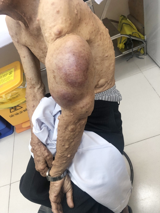 BV Chợ Rẫy phẫu thuật thành công nhiều ca bướu sợi thần kinh lớn ảnh 2