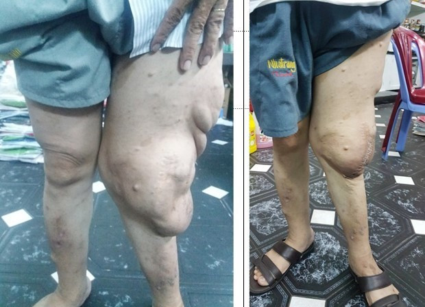 BV Chợ Rẫy phẫu thuật thành công nhiều ca bướu sợi thần kinh lớn ảnh 1