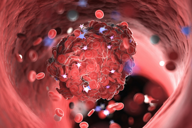 Người mắc COVID-19 có nguy cơ cao hình thành cục máu đông trong phổi ảnh 1