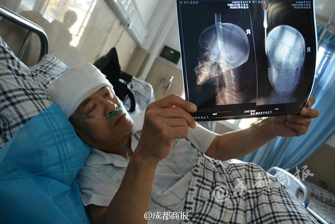 Người đàn ông bị con dao "từ trên trời rơi xuống" cắm thẳng vào đầu ảnh 2