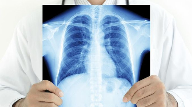 Phát hiện hormone giúp hóa trị điều trị ung thư phổi đạt hiệu quả cao ảnh 1