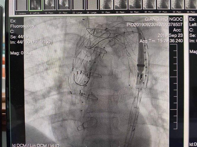 Kết quả can thiệp đặt stent graft động mạch chủ của bệnh nhân. (Ảnh: Mai Trang/TTXVN) TT-Huế: Phẫu thuật thành công bệnh nhân bị bóc tách động mạnh chủ ảnh 1