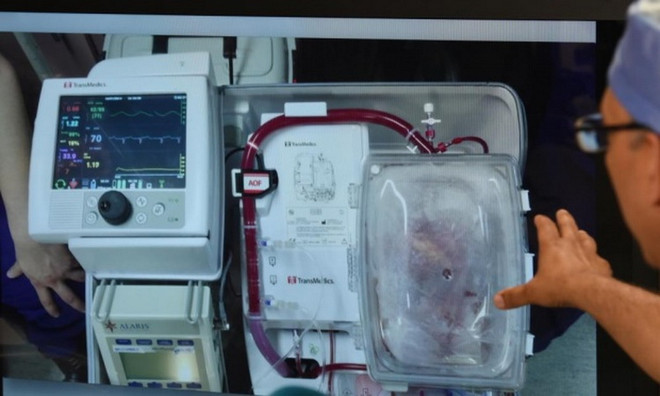 Kỳ tích y học Anh: Cấy ghép thành công tim không còn đập ảnh 1