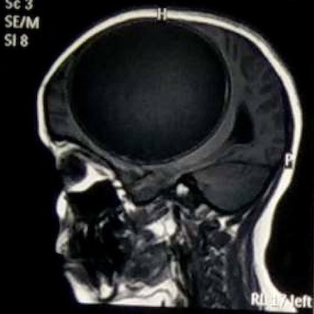 Nang sán dây "lớn nhất lịch sử y học" trong đầu cô bé 12 tuổi ảnh 2