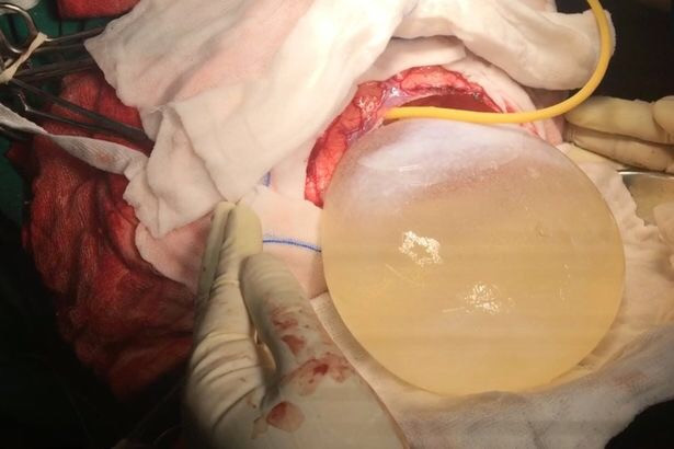 Nang sán dây "lớn nhất lịch sử y học" trong đầu cô bé 12 tuổi ảnh 1