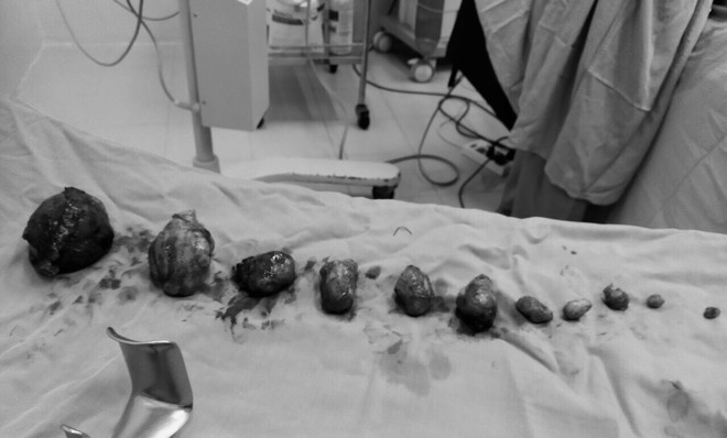 Cần Thơ: Phẫu thuật thành công lấy thai kết hợp bóc nhân xơ tử cung ảnh 1