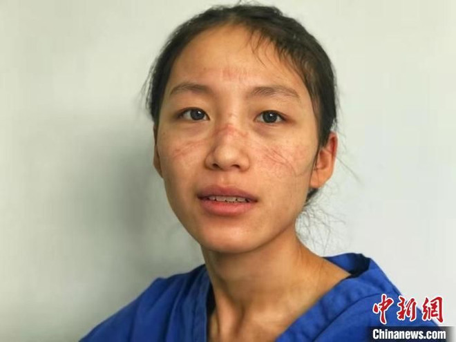 Gương mặt Trần Dĩnh trầy xước và đầy vết hằn do đồ bảo hộ. (Ảnh: China News) Câu chuyện đằng sau nụ hôn qua vách kính của nữ y tá chống COVID-19 ảnh 2