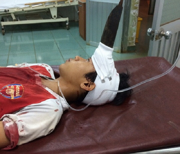 Đắk Nông: Cứu sống bé trai 12 tuổi bị dao phay đâm giữa trán ảnh 1