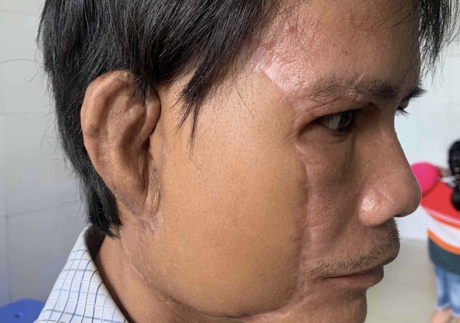 Thực hiện thành công nuôi cấy tai người dưới cẳng tay và cấy ghép lại ảnh 1