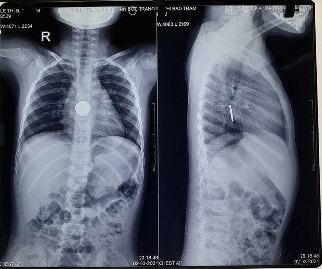 Sóc Trăng: Gắp thành công đồng xu trong bụng một bé gái ảnh 1