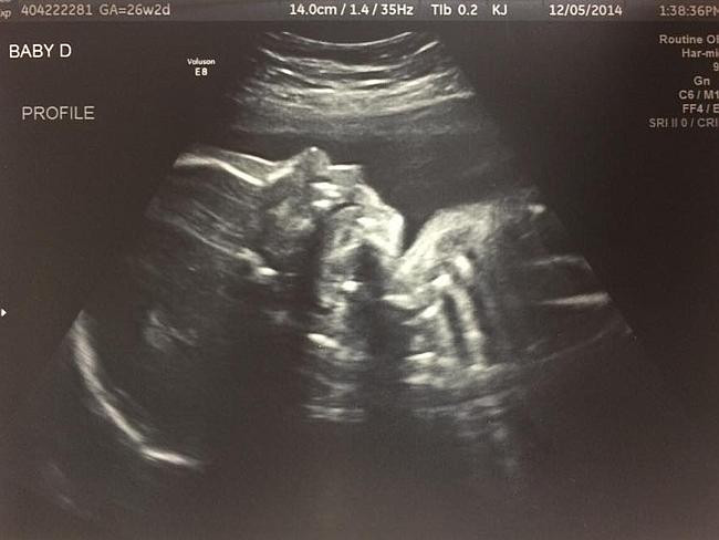 Một bà mẹ người Mỹ sinh bốn cực kỳ hiếm gặp trên thế giới ảnh 3