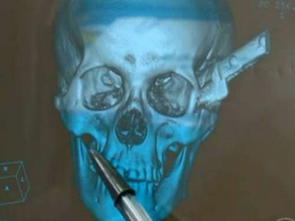 Lái xe hơn 2 giờ đồng hồ đến bệnh viện với con dao cắm trên đầu ảnh 1