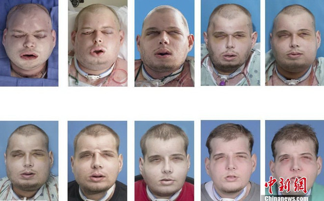 Anh lính cứu hỏa và ca phẫu thuật cấy ghép mặt khó nhất thế giới ảnh 2