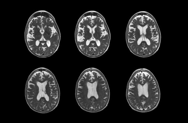 Mỹ: FDA cấp phép lưu hành thuốc Leqembi chữa bệnh Alzheimer ảnh 1