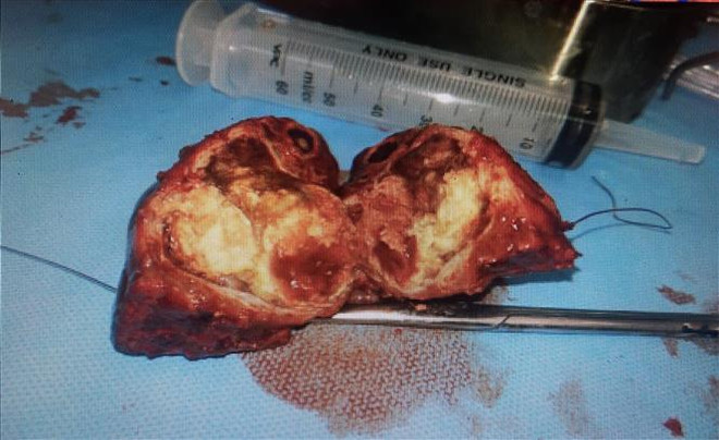 Bệnh viện TW Huế phẫu thuật cắt gan lớn thành công cho hai bệnh nhi ảnh 1