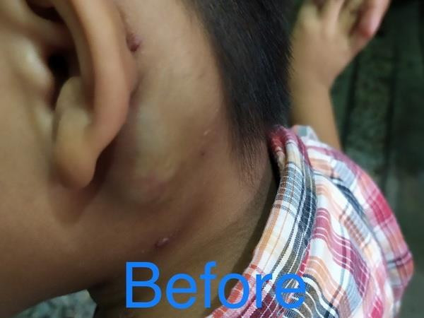 Hình ảnh khối u trước can thiệp. (Ảnh: TTXVN phát) Điều trị cho bệnh nhi bị u máu dạng dị dạng tĩnh mạch sau tai ảnh 1