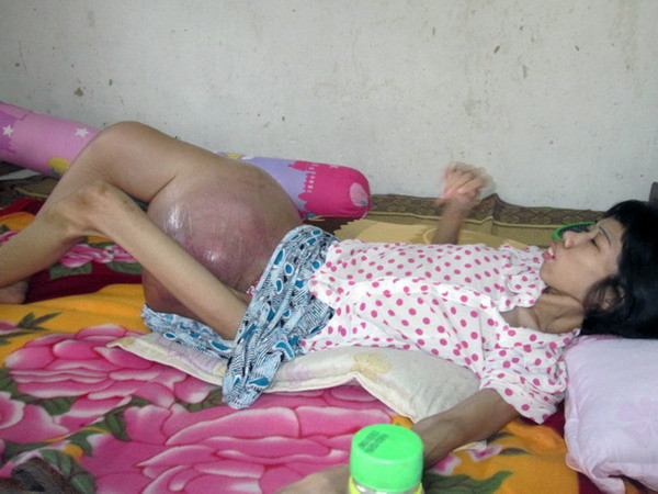 Cảm thương người phụ nữ có khối u nặng gần 10kg ở đùi ảnh 1