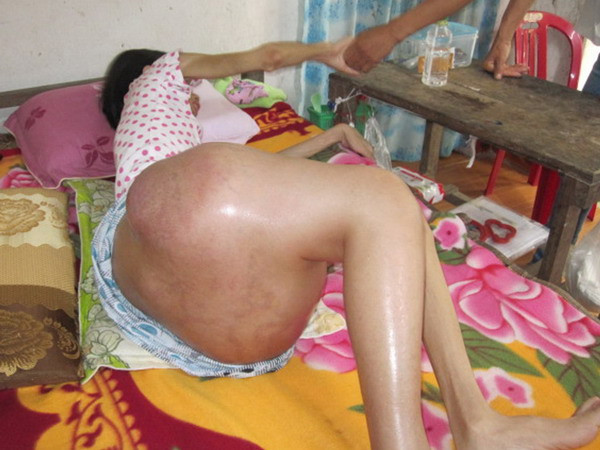 Cảm thương người phụ nữ có khối u nặng gần 10kg ở đùi ảnh 3