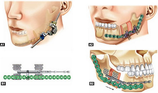 Hành trình kỳ diệu tìm lại khuôn mặt cho bệnh nhân bị lép nửa mặt ảnh 2