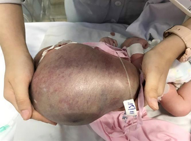TP.HCM: Tách thành công khối bướu khủng cho bé sơ sinh 3 ngày tuổi ảnh 2
