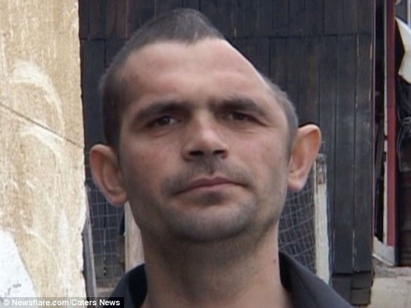 Người đàn ông mất nửa hộp sọ do tai nạn nghề nghiệp ảnh 1