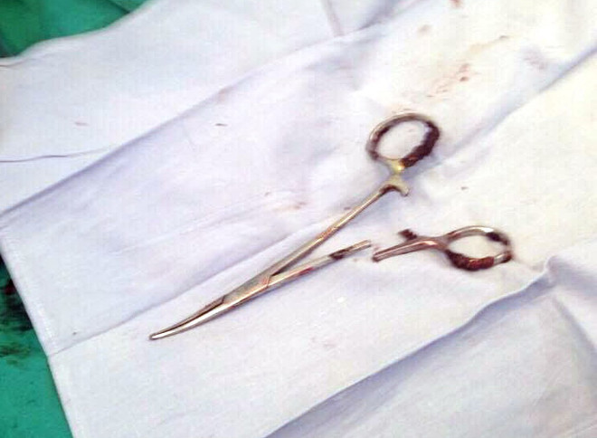 Phẫu thuật lấy chiếc kéo han rỉ 18 năm nằm trong bụng bệnh nhân ảnh 2