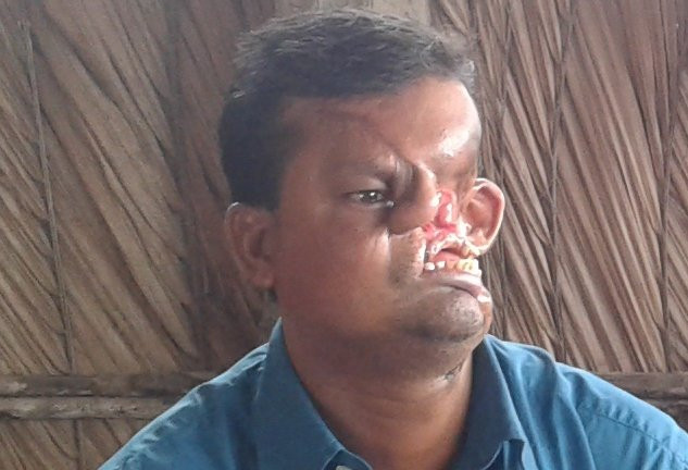 Khuôn mặt biến dạng sau 20 năm của nạn nhân hổ vồ ở Bangladesh ảnh 1