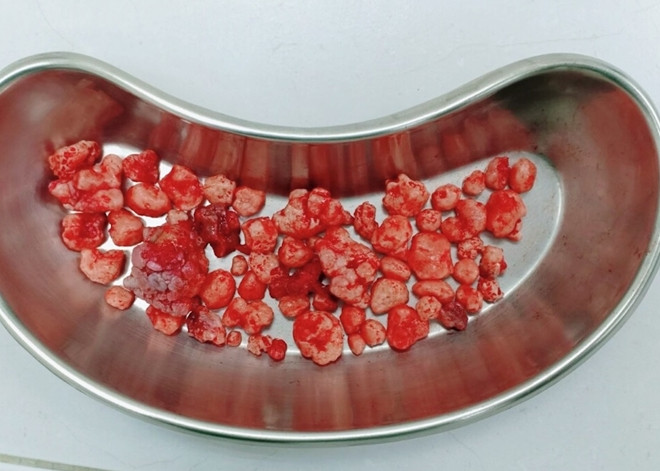 Phẫu thuật gắp 100 viên sỏi trong khớp hàng của một bệnh nhân ảnh 1