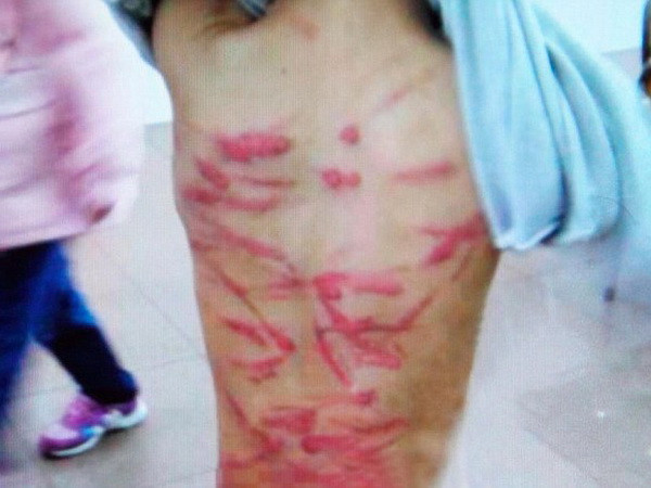 Bé trai 6 tuổi bị mẹ đẻ đánh đập dã man bằng mắc áo ảnh 1