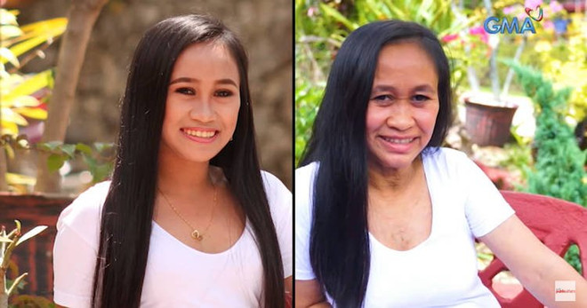 Căn bệnh kỳ lạ khiến cô gái 16 tuổi trông như bà lão 60 ảnh 1