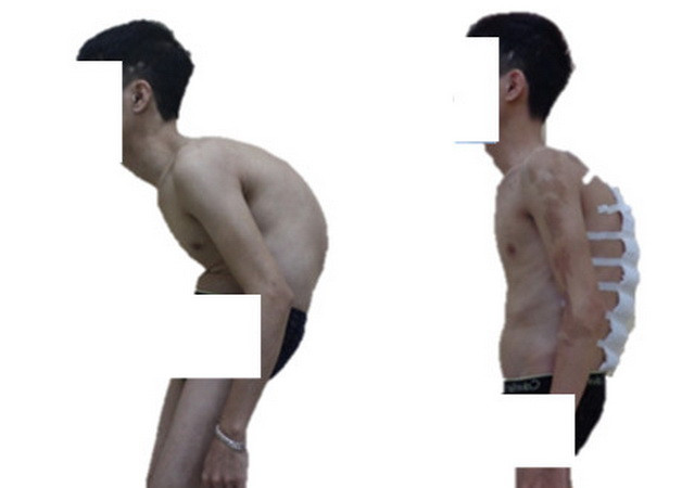 Ảnh chụp nghiêng bệnh nhân trước và sau phẫu thuật. (Nguồn: benhvien108.vn) Nắn chỉnh biến dạng cột sống thành công cho bệnh nhân ''siêu gù'' ảnh 1