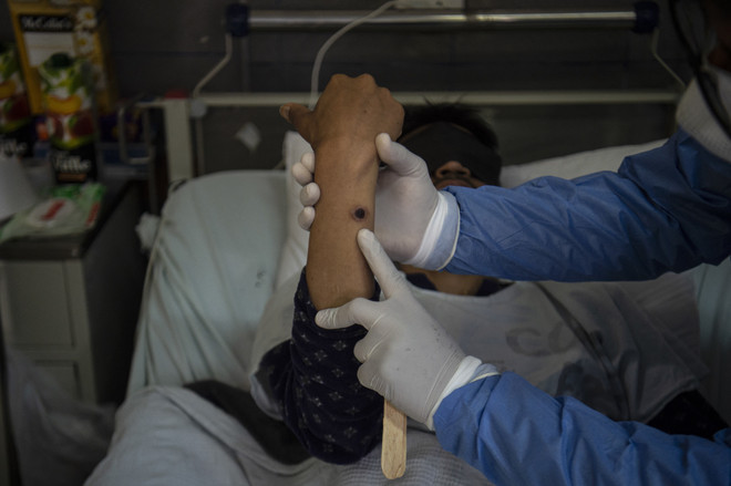 Điều trị cho bệnh nhân mắc đậu mùa khỉ. (Ảnh: AFP/TTXVN) Mozambique ghi nhận trường hợp đầu tiên mắc bệnh đậu mùa khỉ ảnh 1
