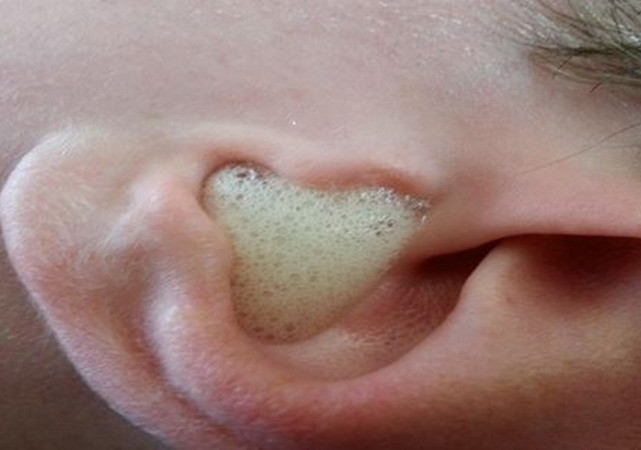 Mẹo nhỏ lấy ráy tai bằng dấm và cồn... không cần tăm bông ảnh 1