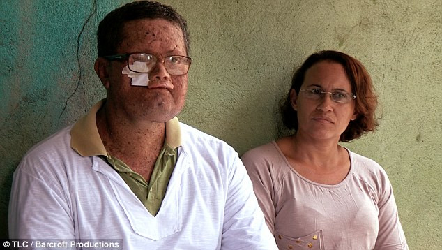 Brazil: Chứng bệnh lạ khiến người dân bị thiêu đốt khi ra nắng ảnh 1